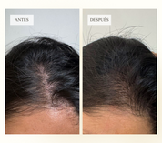 Antes y después resultados del Hair Oil Dermanat